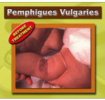 PEMPHIGUS VULGARIS