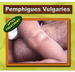 PEMPHIGUS VULGARIS